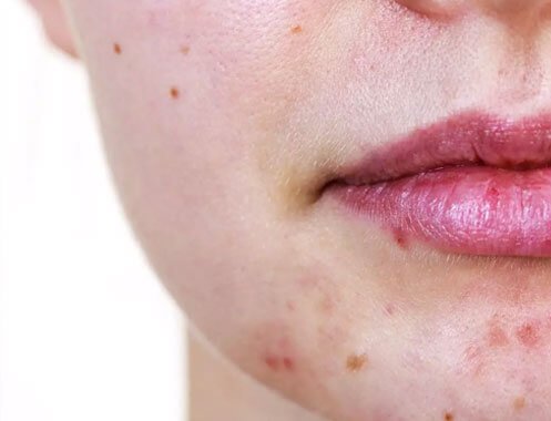 ACNE Cosmetic treatment Manchester