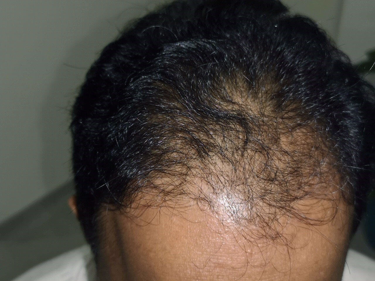 Skin Pigmentation Specialist Hairloss after