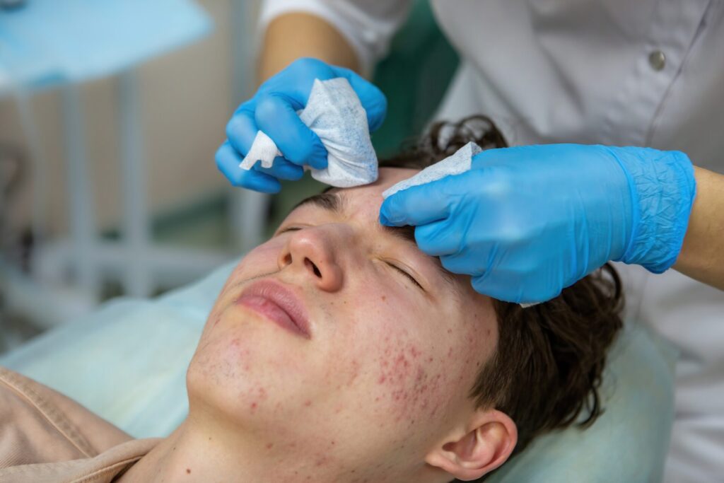 Chemical Peel Help with Acne