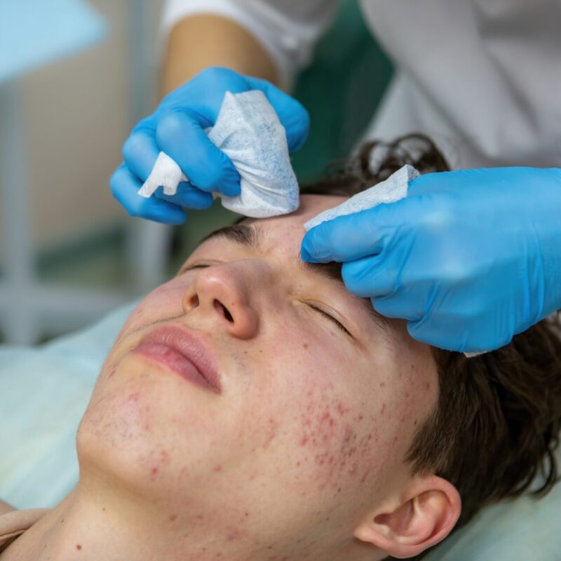 Chemical Peel Help with Acne