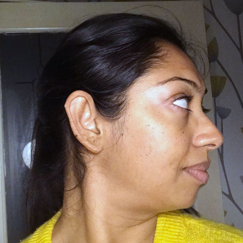 superficial peel