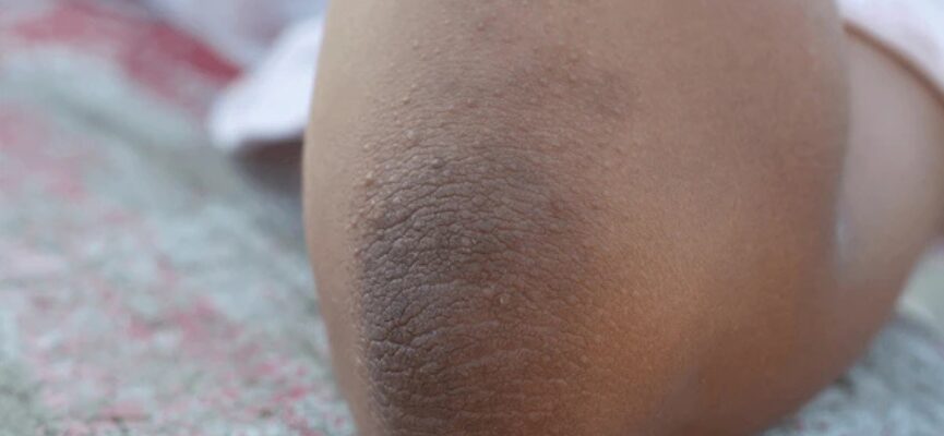Acanthosis nigricans 1