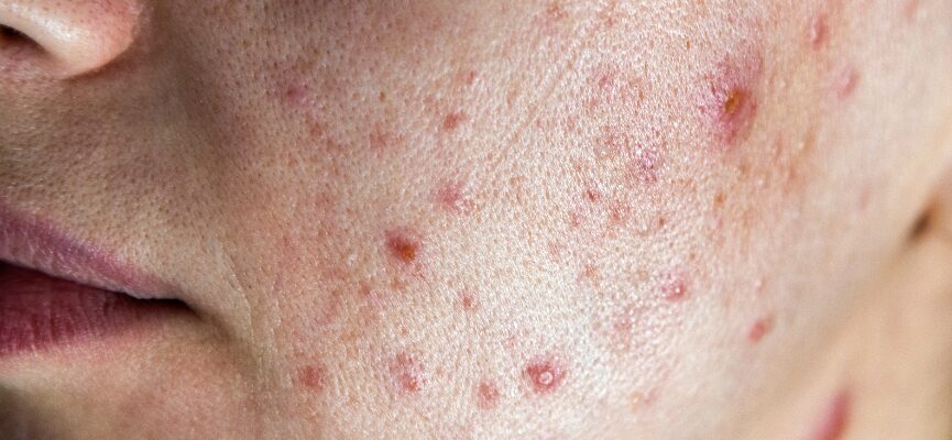 Acne 1