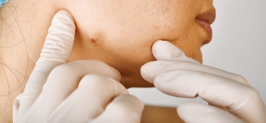 Actinic Keratoses 1