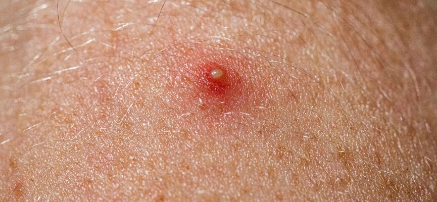 Cysts 1