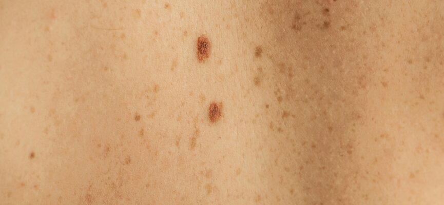Dermatosis Papula Nigra (DPN) 1