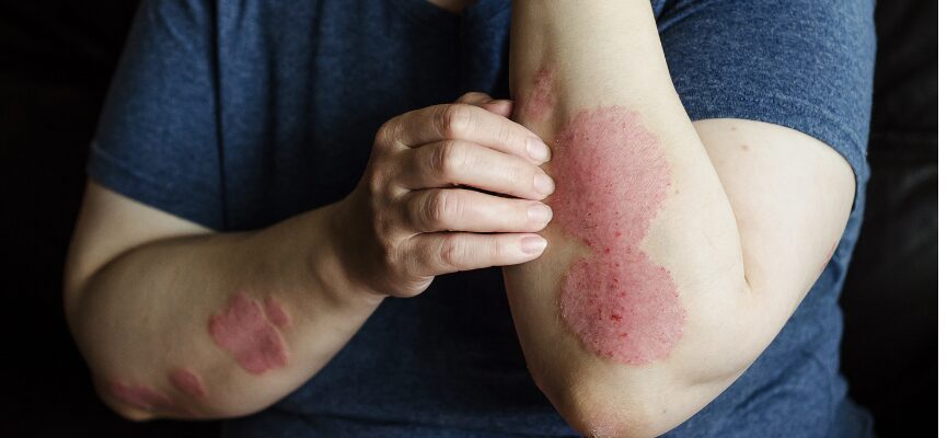 Eczema 1