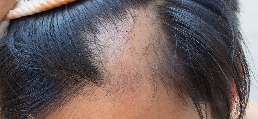 Hair loss (Alopecia) 1