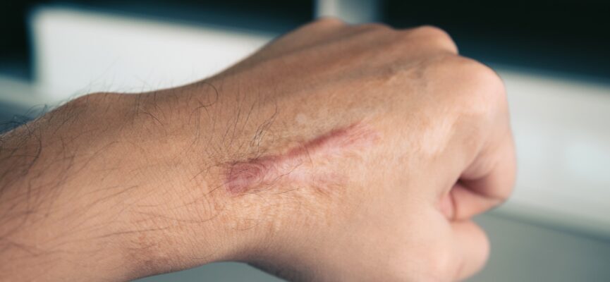 Keloid Scars 1