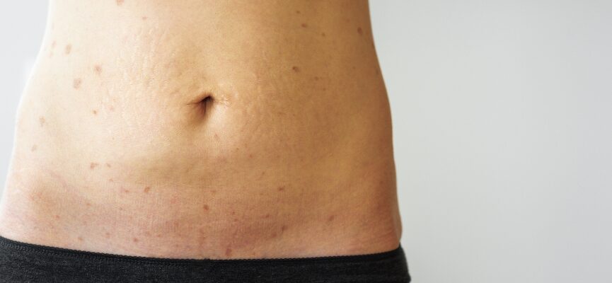 Lichen planus pigmentosus 1