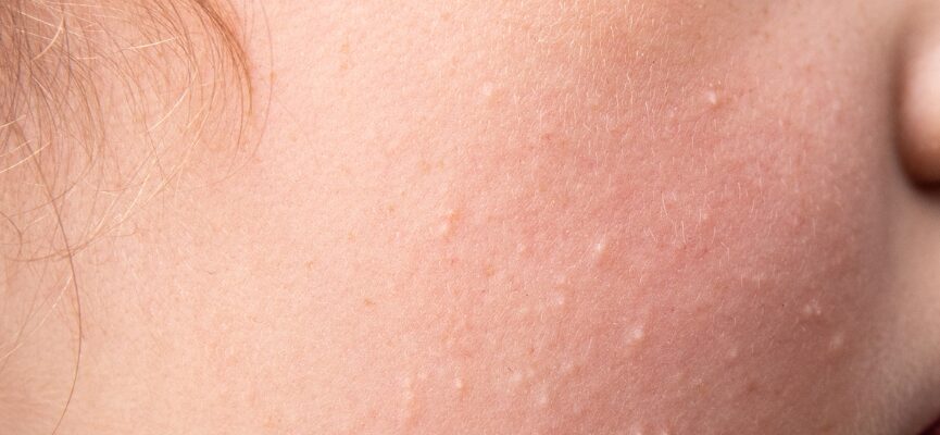Lumps & Bumps 1