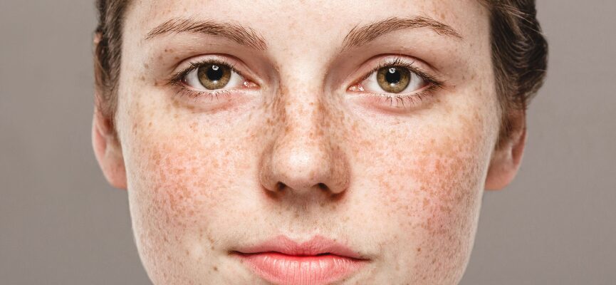 Melasma 1