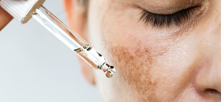 Post Inflammatory Hyperpigmentation (PIH) 1