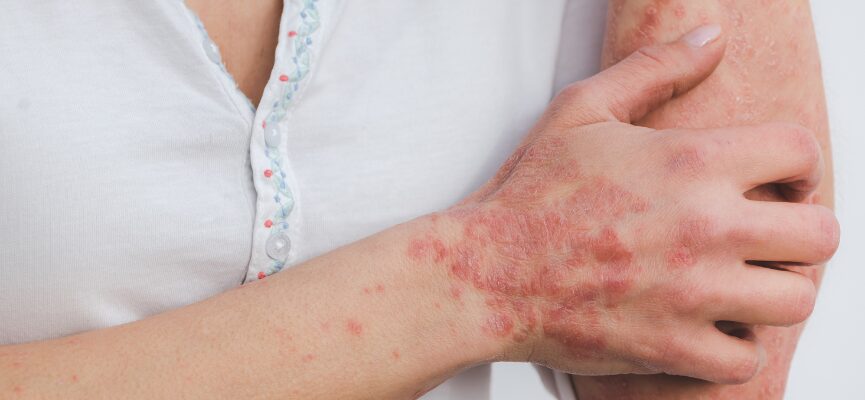 Psoriasis 1