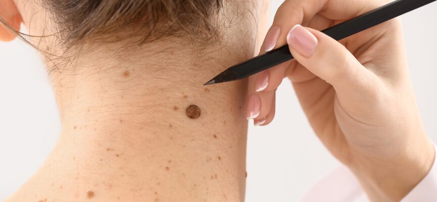 Removal Of Moles 1