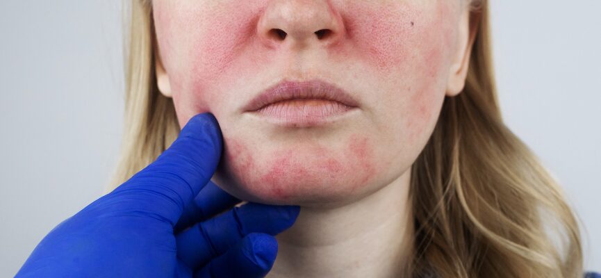 Rosacea 1