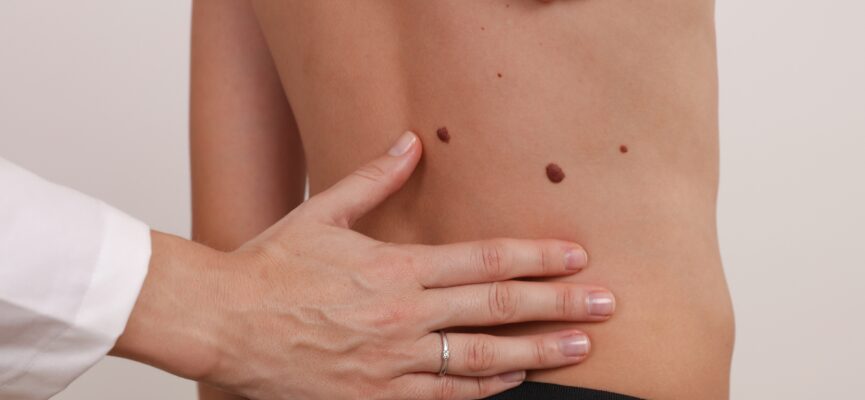 Skin Tags 1
