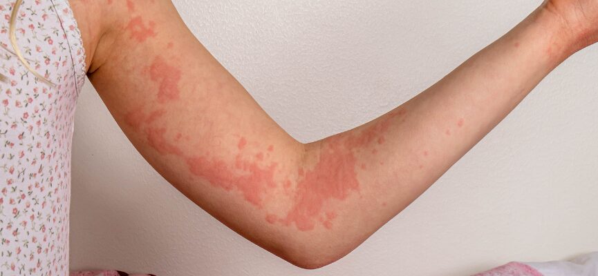 Urticaria 1