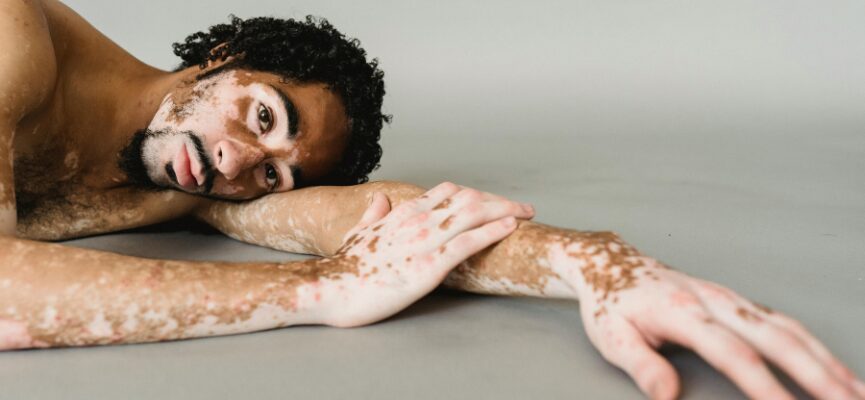 Vitiligo 1