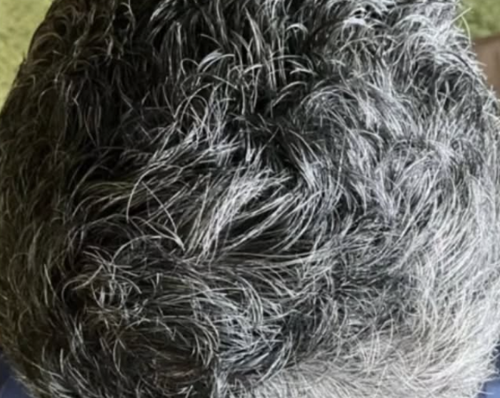 alopecia after