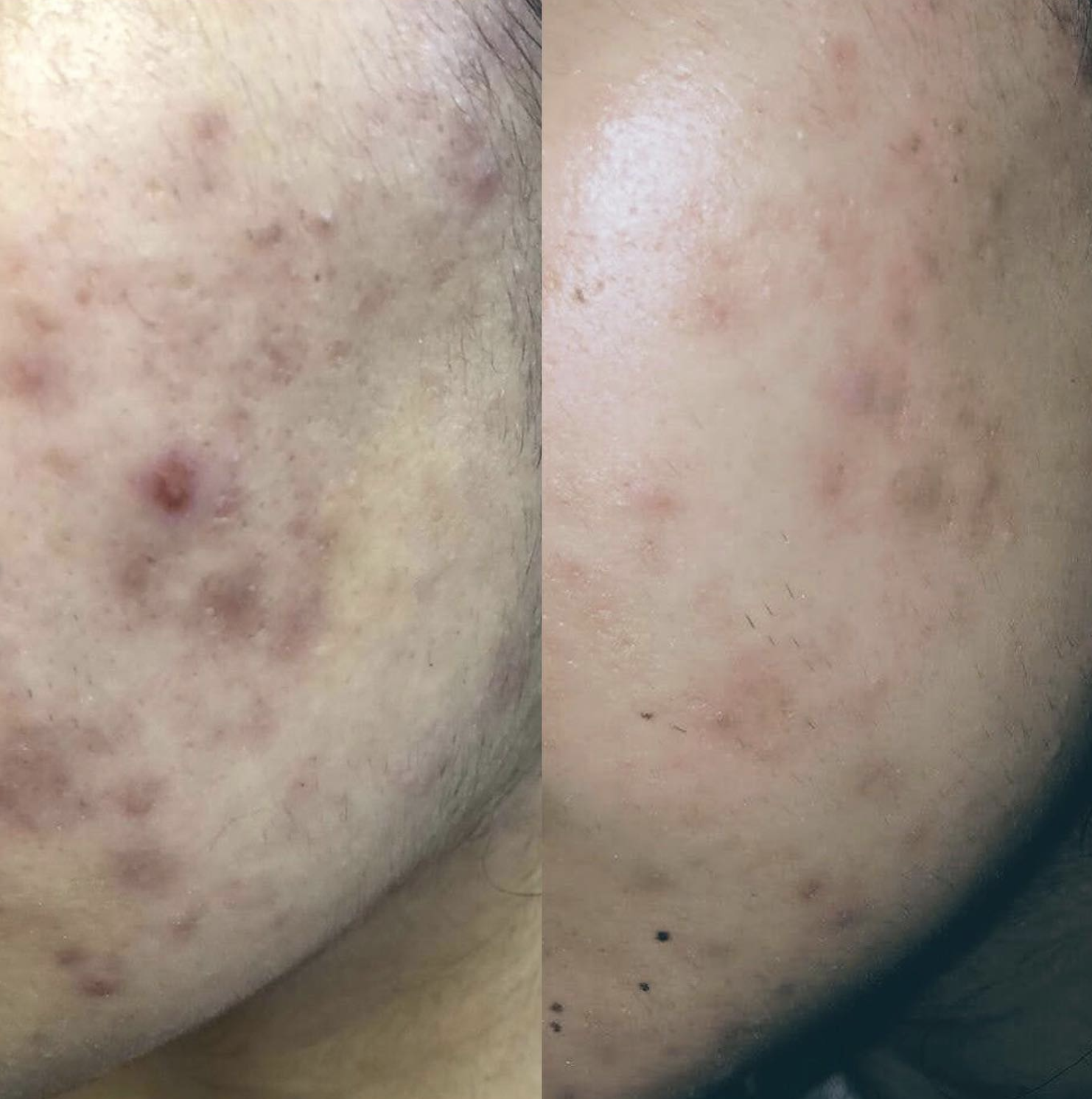 chemical peel before after