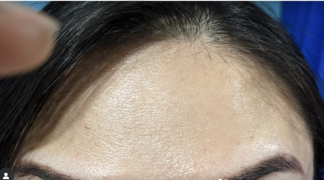 dermal fillers after