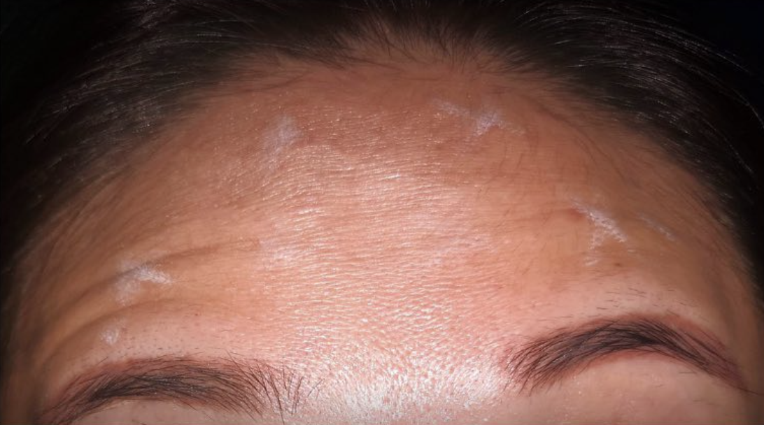 dermal fillers before