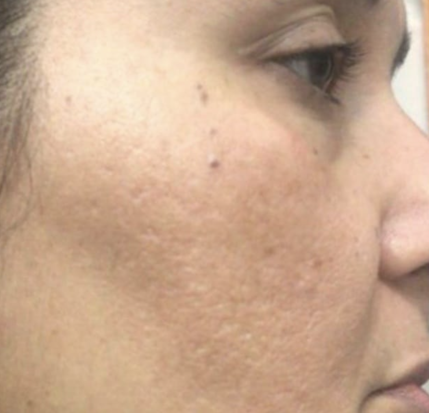 laser treatment before