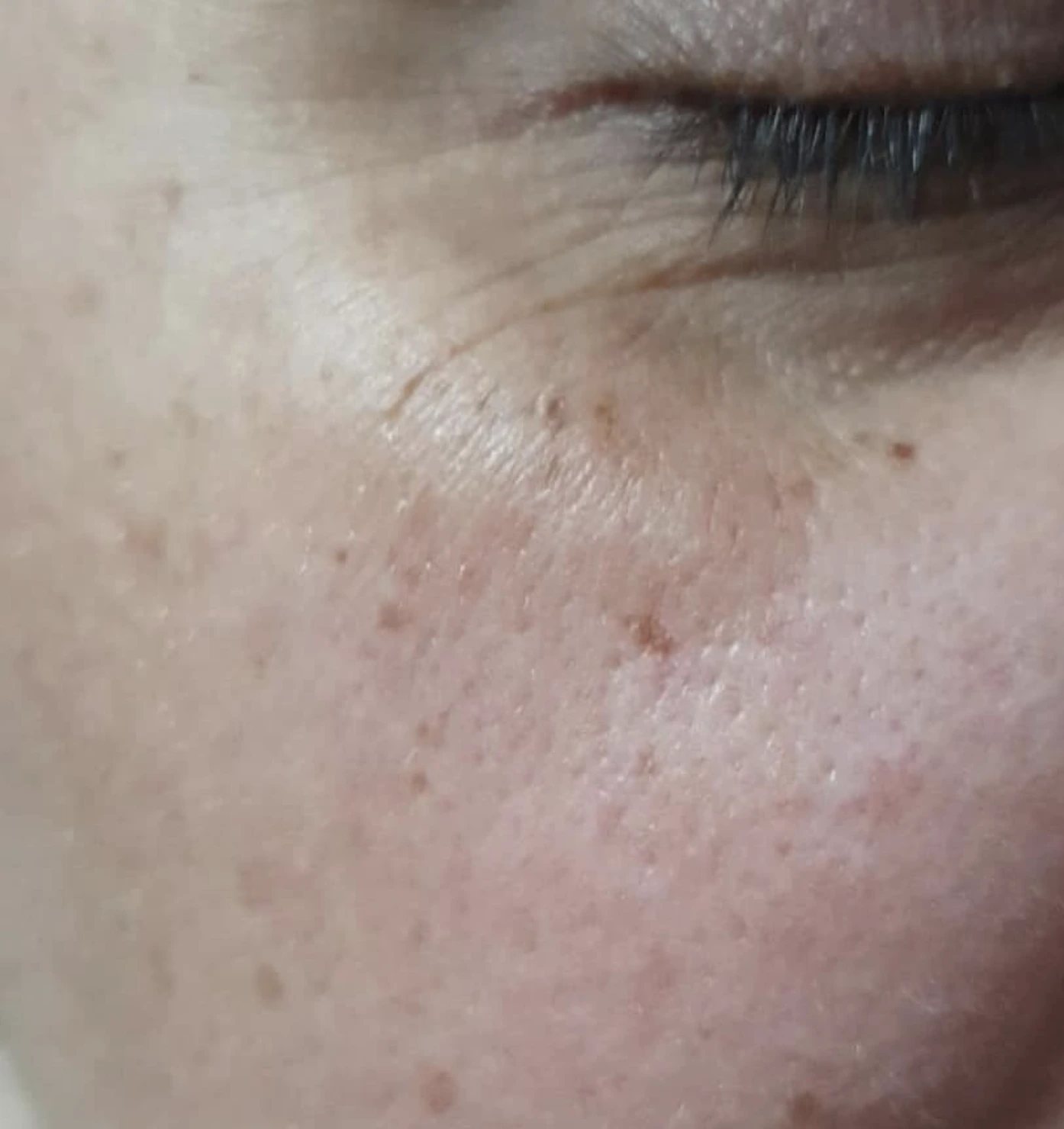 melasma after