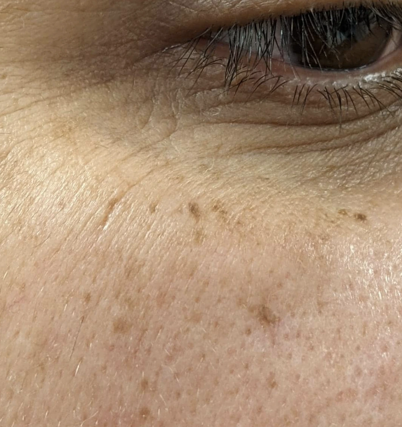 melasma before